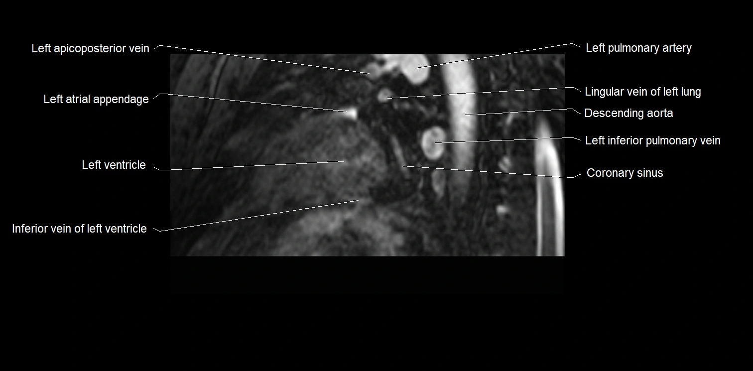 MRI heart and coronary arteries two chamber(sagittal)  anatomy image 36.webp